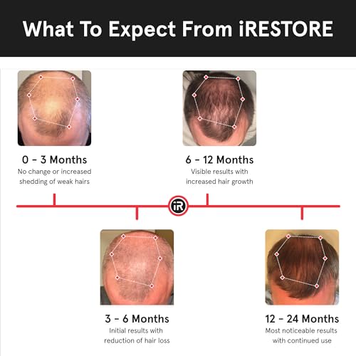 iRestore Professional 282 | FDA Cleared Laser Hair Growth Device | Red Light Therapy for Hair Growth | Laser Cap for Hair Regrowth, Restore Laser Helmet, Hair Loss Treatments for Men & Women Alopecia