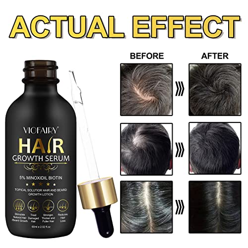 5% Minoxidil for Men and Women Hair Growth Oil, Biotin Hair Growth Serum Hair Regrowth Treatment for Scalp Hair Loss Hair Thinning, Natural Hair Growth for Thicker Longer Fuller Healthier Hair 2.02 oz